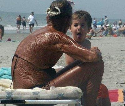 sunburn.jpg
